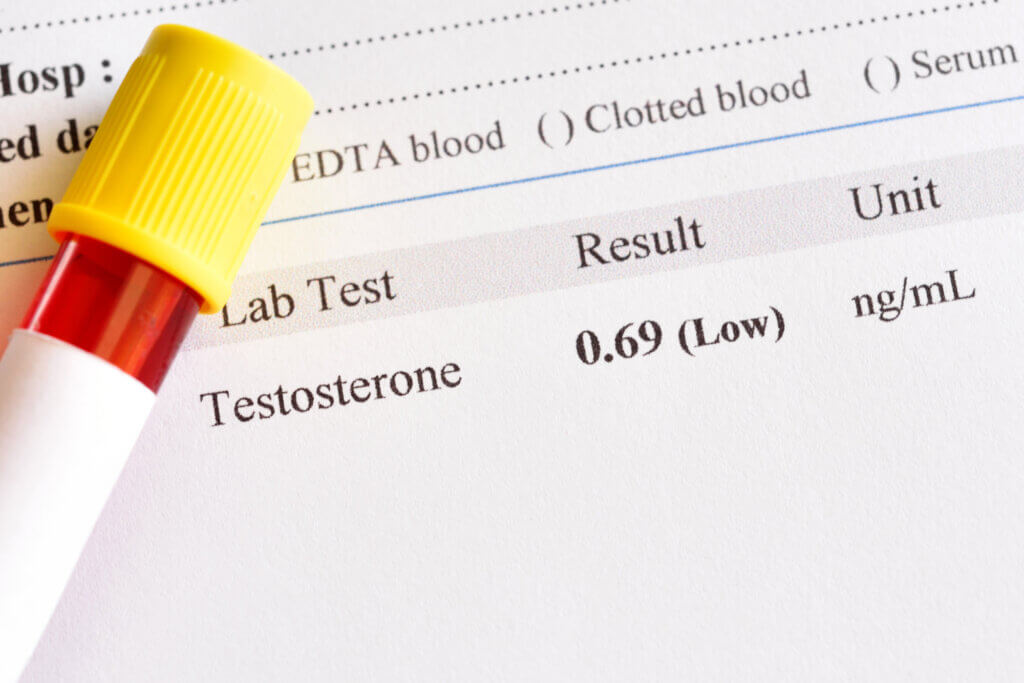 low testosterone on lab test sheet